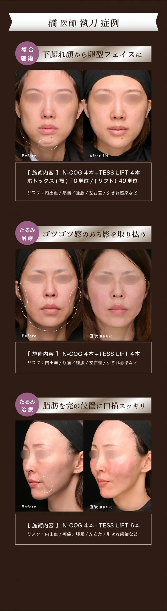 【橘医師限定】 新糸リフトメニュー誕生