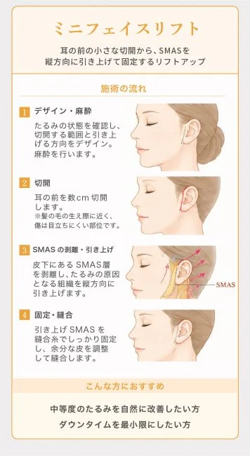 【期間限定】 ミニフェイスリフトキャンペーン
