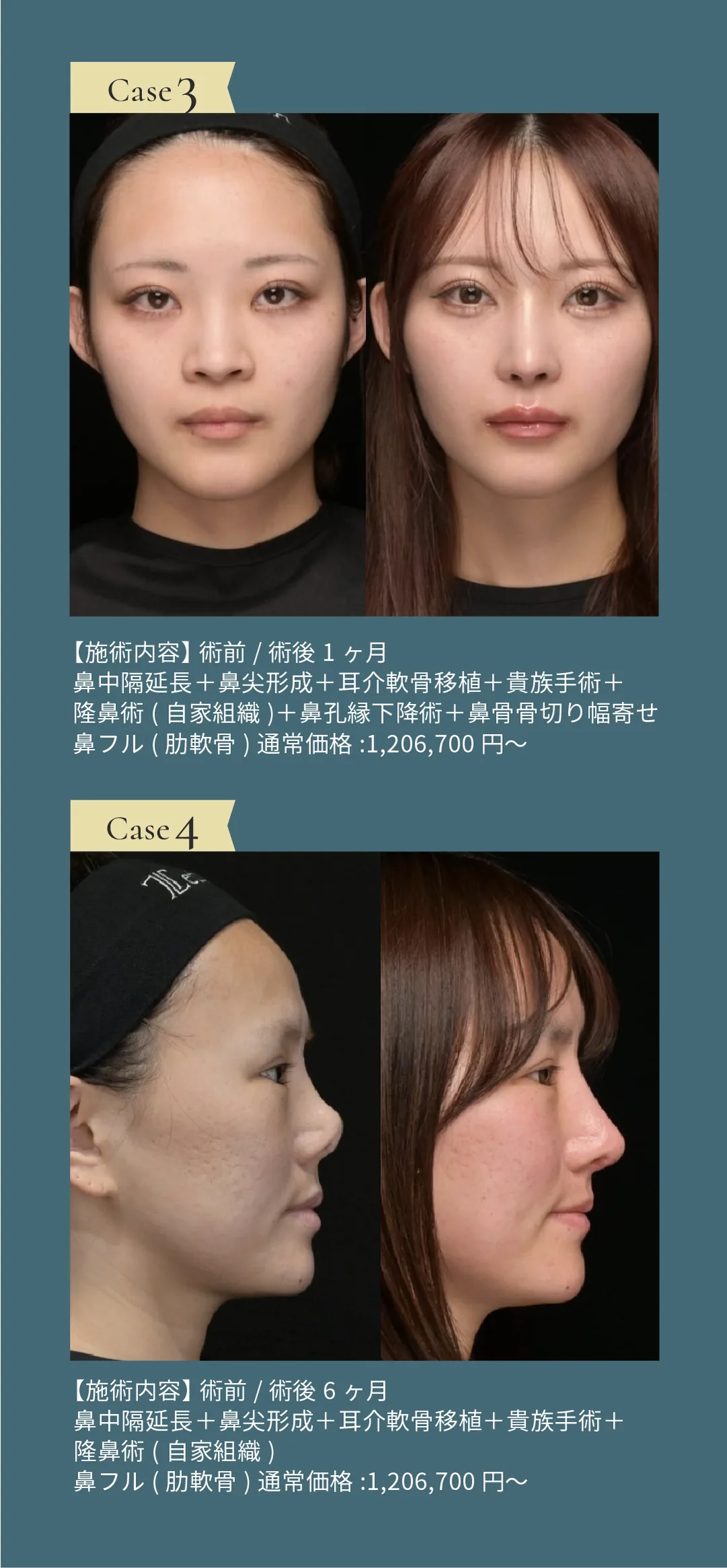 【鼻のスペシャリスト】 鉄医師の鼻整形