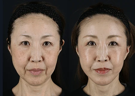 フェイスリフトと脂肪吸引・脂肪注入の術前と術後半年の比較(正面)