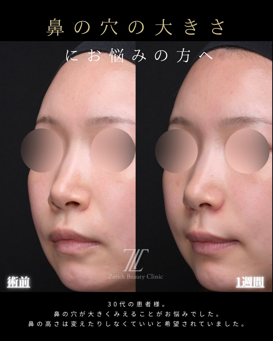 鼻翼縮小(小鼻縮小)斜め 術前・術後1週間