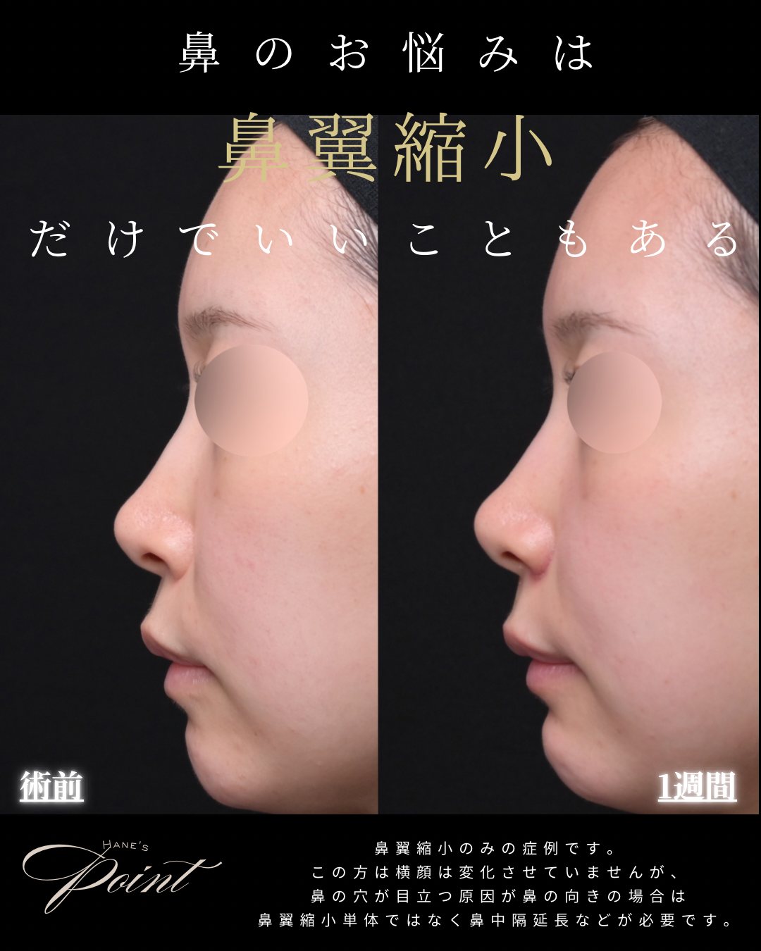 鼻翼縮小(小鼻縮小)横 術前・術後1週間