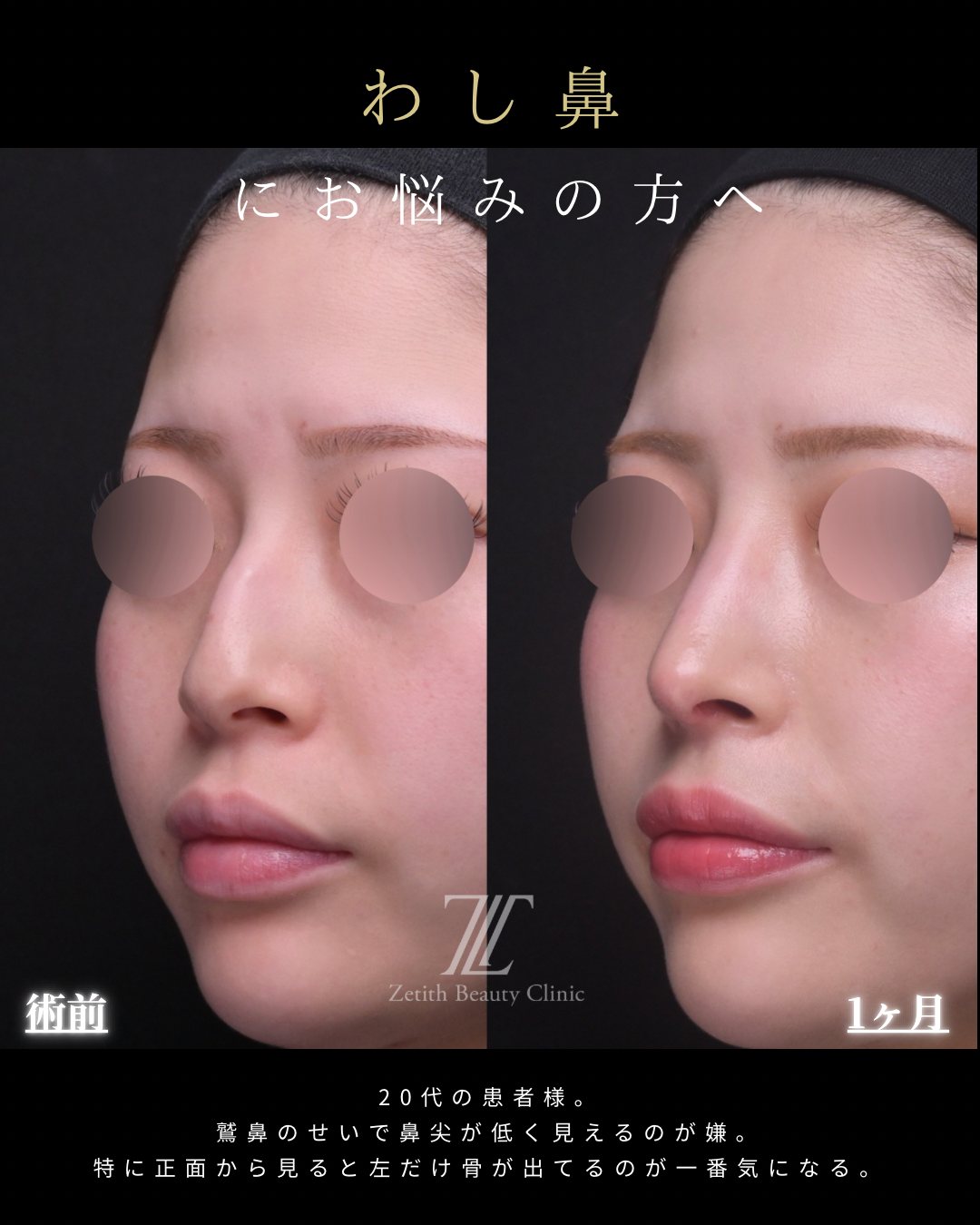 わし鼻・鷲鼻修正 斜め 術前・術後1ヶ月