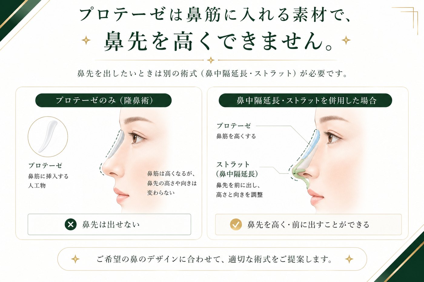 【図解】プロテーゼは鼻筋に入れる素材で鼻先を高くできない。プロテーゼのみでは鼻先は出せず、鼻中隔延長・ストラットを併用すると鼻先を高く・前に出せる、の比較図